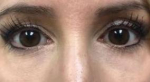 Restylane<sup>®</sup> Before and After Case 1 After