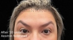 Xeomin (10 Units Forehead) Case-10 After