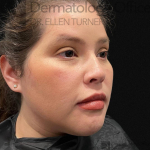 EMFACE (1 treatment) Before and After Case-40 After