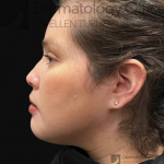 EMFACE (1 treatment) Before and After Case-43 After