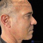 EMFACE (4 treatments) Before and After Case-48 After