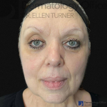EMFACE (4 treatments) Before and After Case-49 Before