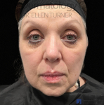 EMFACE (4 treatments) Before and After Case-49 After