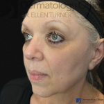 EMFACE (4 treatments) Before and After Case-50 Before