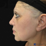 EMFACE (4 treatments) Before and After Case-51 Before