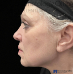EMFACE (4 treatments) Before and After Case-51 After