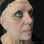 EMFACE (4 treatments) Before and After Case-53 Before