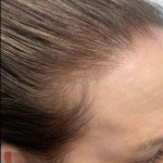 Platelet-Rich Plasma Before and After (1 treatment) Case-9 Before
