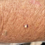 Skin Cancer (Excision) Case-79 Before