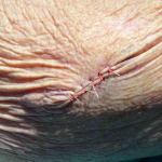 Skin Cancer (Excision) Case-79 After