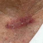 Skin Cancer (Excision) Case-80 After