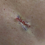 Skin Cancer (Excision) Case-81 After