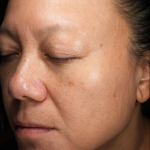 Picocare 450 (4 treatments) Before and After Case-5 Before