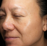 Picocare 450 (4 treatments) Before and After Case-5 After
