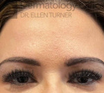 Botox (25 Units) Case-20 After