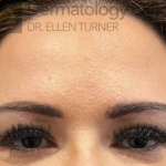 Botox (25 Units) Case-20 After