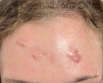 Zero Gravity (3 treatments) Before and After Case-1 Before