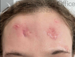 Zero Gravity (3 treatments) Before and After Case-1 After