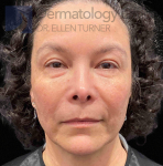EMFACE (4 treatments) Before and After Case-54 Before