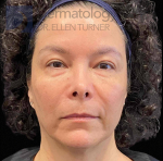 EMFACE (4 treatments) Before and After Case-54 After