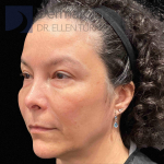 EMFACE (4 treatments) Before and After Case-55 Before