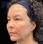 EMFACE (4 treatments) Before and After Case-55 After