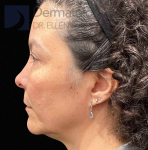 EMFACE (4 treatments) Before and After Case-56 Before