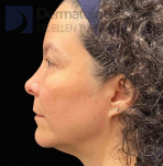 EMFACE (4 treatments) Before and After Case-56 After