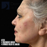 Snatch and Lift (4 treatments EMFACE and 4 syringes Volux XC) Before and After Case-1 After