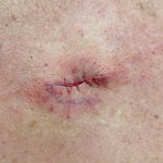 Skin Cancer (Excision) Case-82 After