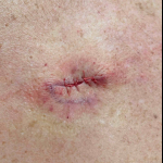 Skin Cancer (Excision) Case-82 After