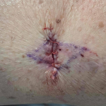 Skin Cancer (Excision) Case-83 After