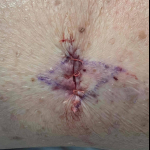 Skin Cancer (Excision) Case-83 After