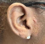 Keloids Before and After Case-18 After
