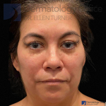 EMFACE (4 treatments) Before and After Case-57 After