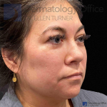 EMFACE (4 treatments) Before and After Case-58 Before