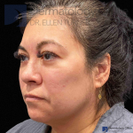 EMFACE (4 treatments) Before and After Case-59 Before