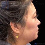 EMFACE (4 treatments) Before and After Case-60 Before