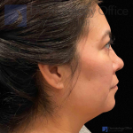 EMFACE (4 treatments) Before and After Case-60 After