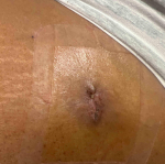 Cyst Removal Before and After Case-30 After