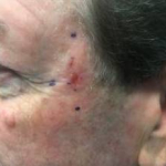Skin Cancer Before and After Case 1 Before