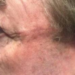 Skin Cancer Before and After Case 1 After