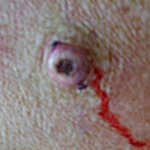 Skin Cancer Before and After Case 2 Before