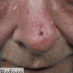 Skin Cancer Before and After Case 4 Before