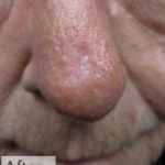 Skin Cancer Before and After Case 4 After