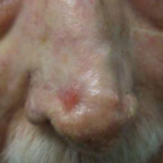 Skin Cancer Before and After Case 5 After