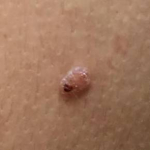 Skin Cancer Before and After Case 6 Before