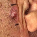 Skin Cancer Before and After Case 7 Before