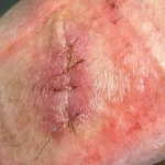 Skin Cancer Before and After Case 8 Before