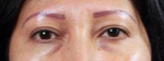 Restylane<sup>®</sup> Before and After Case 4 Before